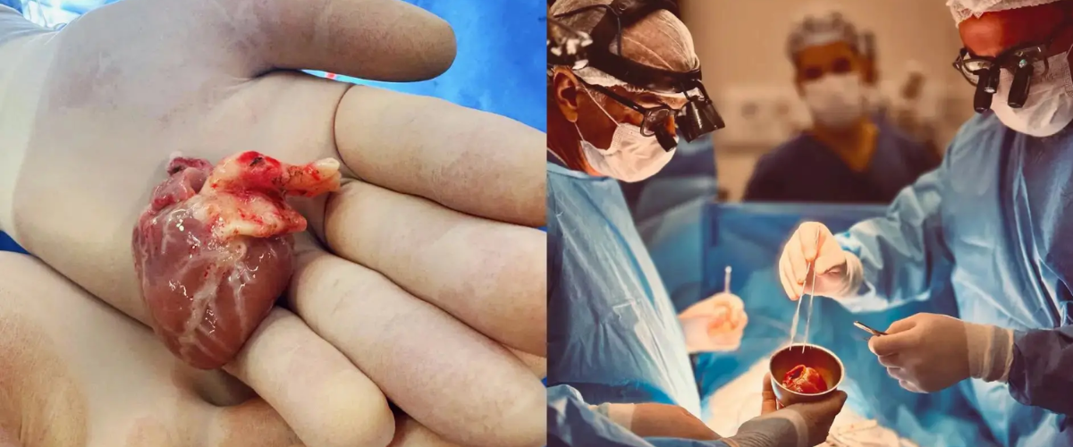 São realizados primeiros transplantes cardíacos pediátricos em Hospital Universitário do Ceará